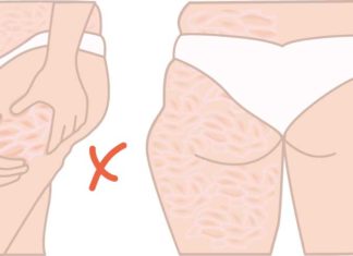 Lipoedeem: Chronische aandoening van het vetweefsel Afslankstudio Gracili - Lipoedeem - Chronische aandoening van het vetweefsel